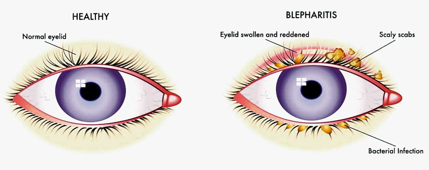 850x338 Blepharitis 001