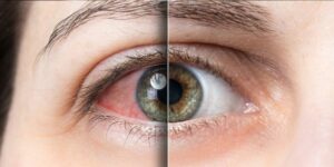 Dry Eye